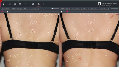 FotoFinder Bodyscan