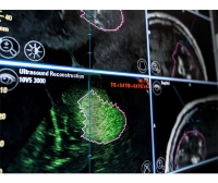 Intraoperative Ultrasound