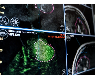 Intraoperative Ultrasound