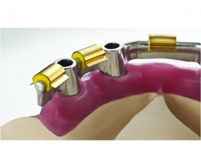 Straumann® CARES® Screw-Retained Bridges and Bars